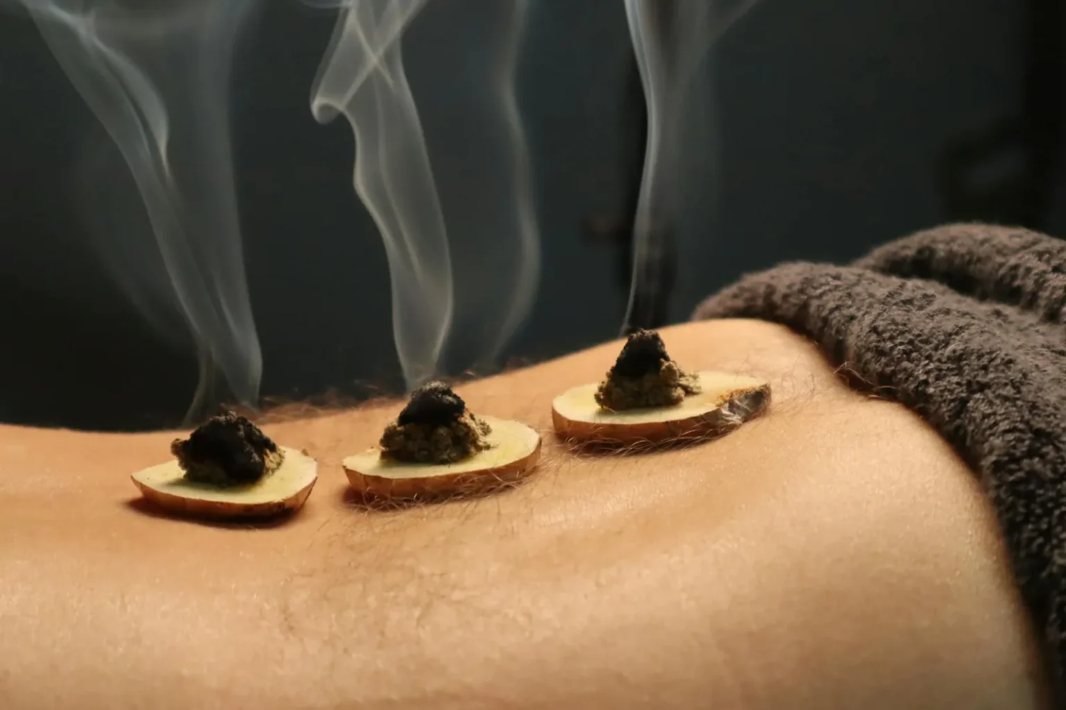 Close-up of traditional moxibustion therapy with smoke rising from moxa cones.